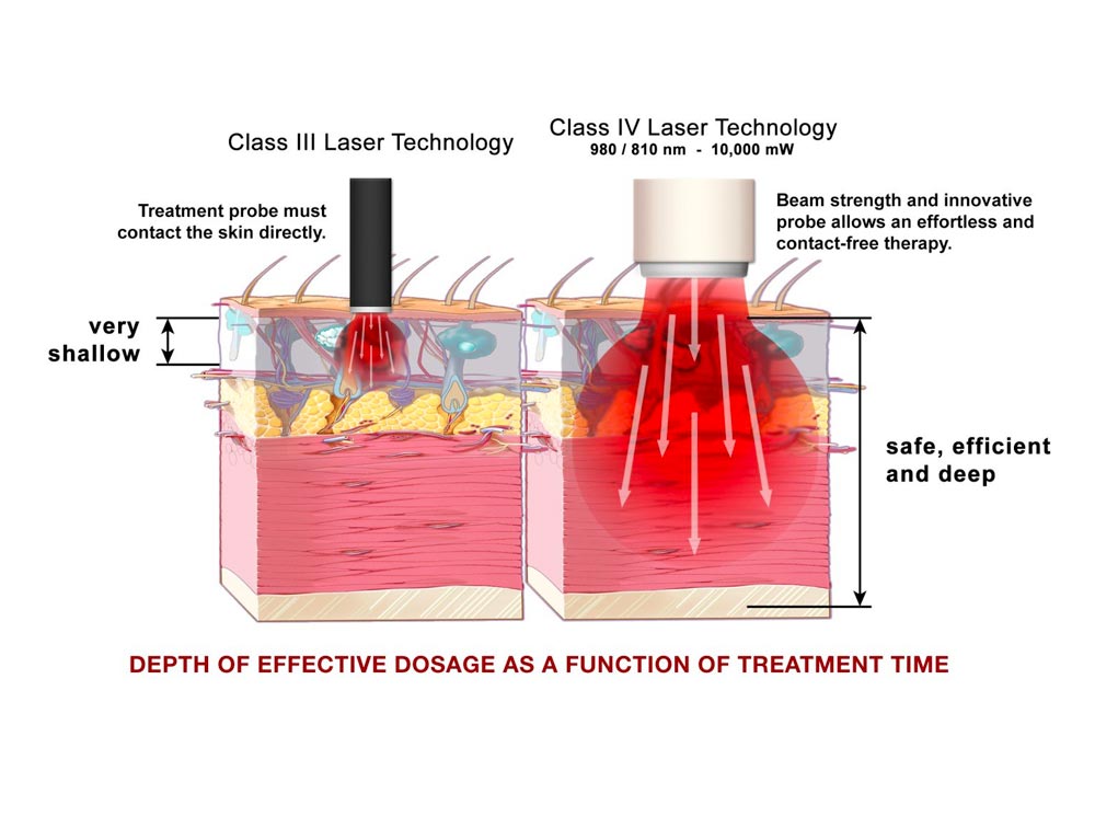 Vendita laser fibra ottica fisioterapia