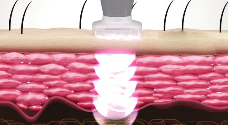 Emissione Pulsata